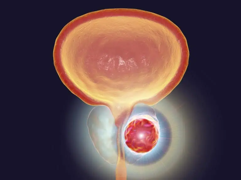 увеличена простата